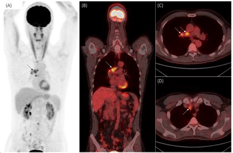 What Causes Lymph Nodes to Light Up on PET Scan: A Journey Through the Mysteries of Cellular Activity and Beyond